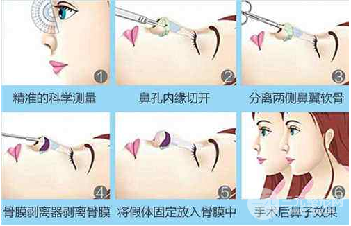 假體隆鼻手術(shù)降低風(fēng)險嗎