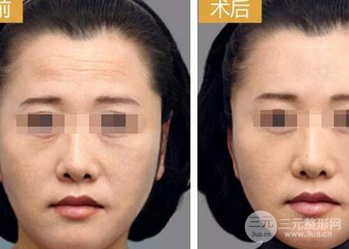 抬頭紋手術(shù)有哪些