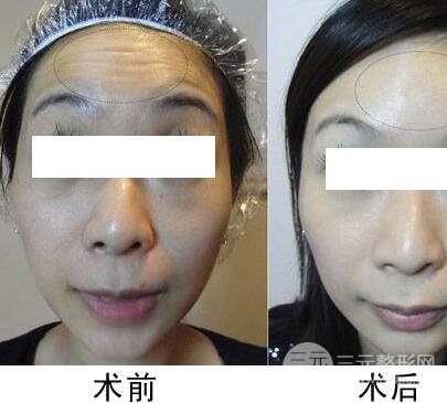 抬頭紋手術(shù)有哪些