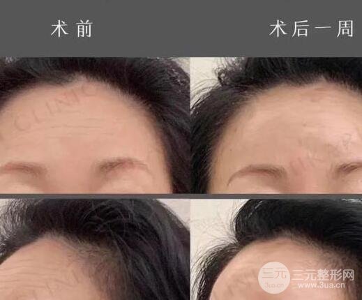 抬頭紋手術(shù)有哪些