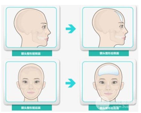 額頭整形術(shù)前后圖片