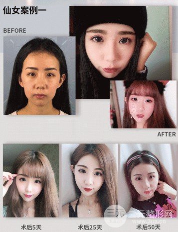 額頭整形術(shù)前后圖片