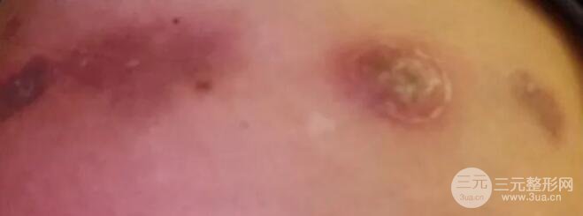 驚恐|自體脂肪移植隆臀，屁股爛了？