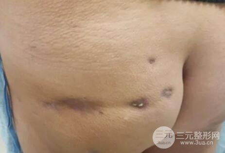 圖2. 求美者左邊臀部術(shù)后4個月，多呈紫褐色凹陷、軟斑、黃斑。中心病變，擠壓白色角化物，以獲得皮膚活檢。