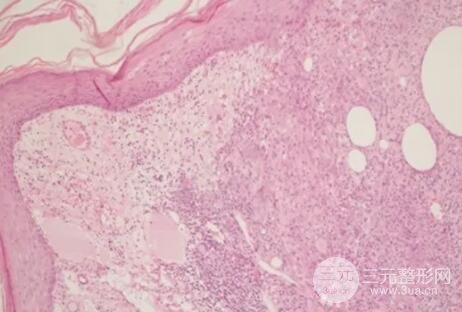 貨源優(yōu)質(zhì)有發(fā)炎的地方，有組織細(xì)胞巨細(xì)胞，淋巴細(xì)胞,。(蘇木精-伊紅染色;原放大倍數(shù)：×40.)