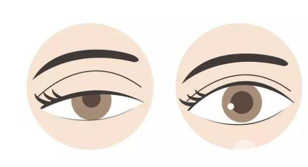 注射瘦臉注射后上瞼下垂，要多久可以復原？