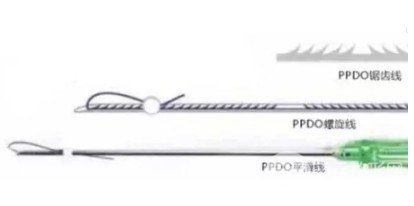 熱瑪吉和埋線除皺哪個好