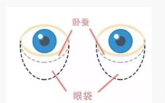 祛眼袋手術(shù)果可以維持多久?