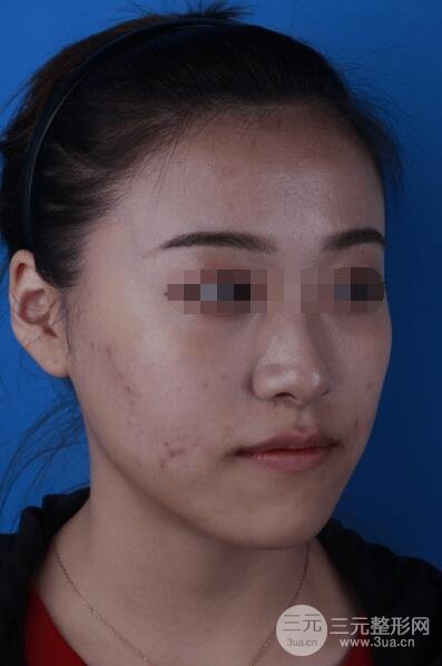 彩光祛痘案例分享