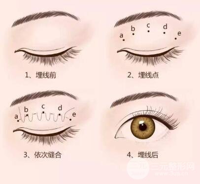 高分子埋線雙眼皮原理