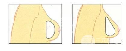 上海九院隆胸大概多少錢(qián)?幾有做呢?