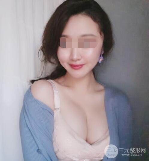 上海九院隆胸案例術(shù)后3個(gè)月