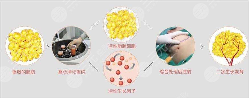 脂肪移植隆胸降低風險嗎?