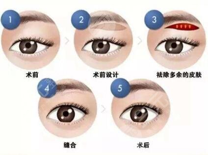 切眉術(shù)會(huì)留下傷疤嗎?