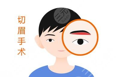 切眉術(shù)進(jìn)程介紹