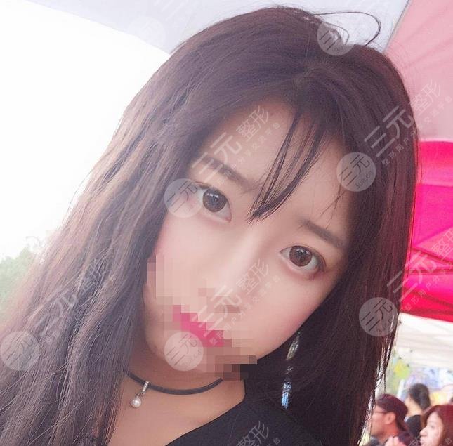 堵頂云雙眼皮案例