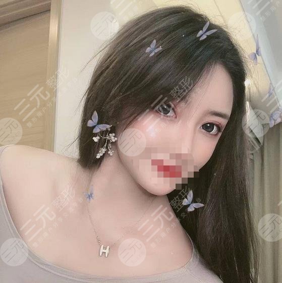 堵頂云雙眼皮案例