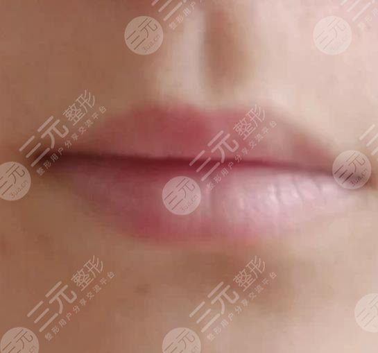 福建省立醫(yī)院整形外科玻尿酸豐唇