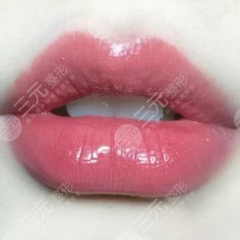 福建省立醫(yī)院整形外科玻尿酸豐唇