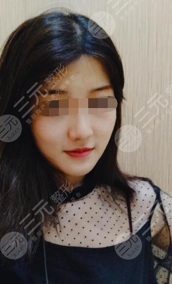 面部溶脂果后6周