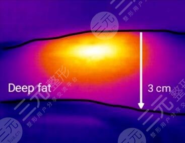 火鳳凰溶脂的優(yōu)勢(shì)
