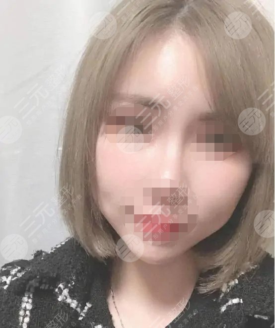 五v明星是埋線(xiàn)除皺?知識(shí)科普來(lái)嘍！附真人案例！