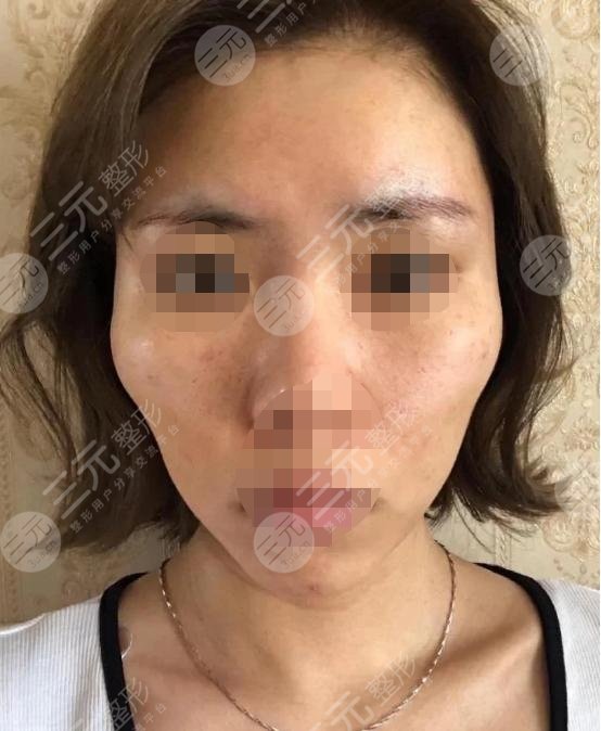 五v明星是埋線(xiàn)除皺?知識(shí)科普來(lái)嘍！附真人案例！