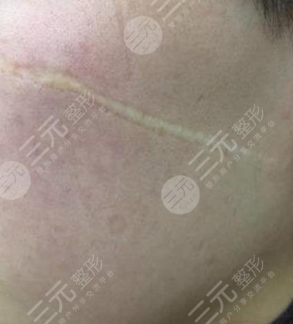 遵義醫(yī)學院附屬醫(yī)院整形祛疤案例