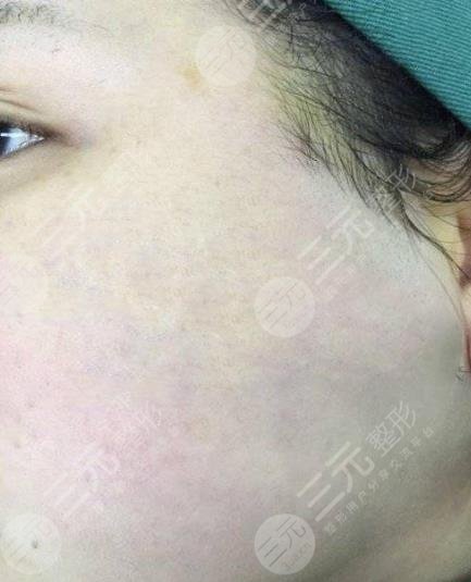 遵義醫(yī)學院附屬醫(yī)院整形祛疤案例