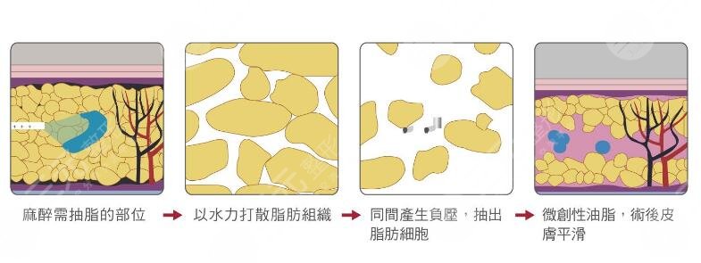火鳳凰微創(chuàng)溶脂原理