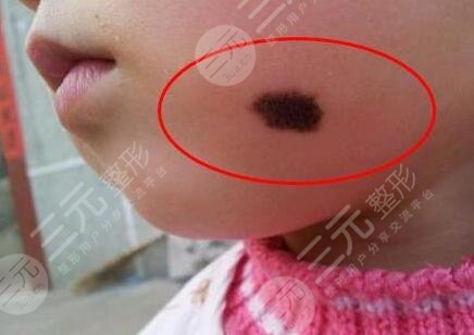 胎記怎么去除?