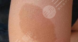 胎記去除掛什么科?