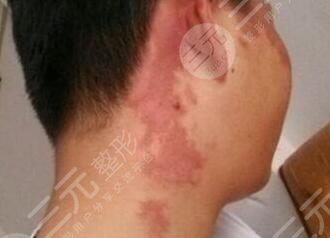 去除胎記后的護(hù)理