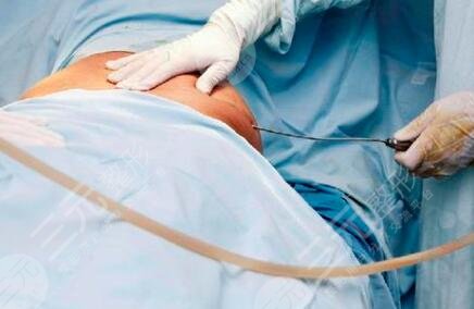 什么是吸脂減肥塑型