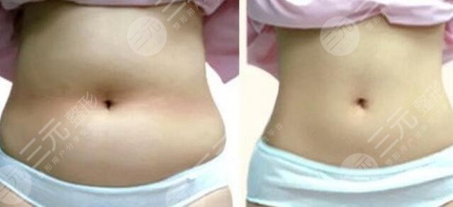 減肥塑型手術(shù)優(yōu)勢(shì)