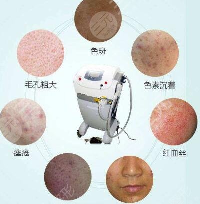 濟(jì)南歐洲之星點(diǎn)陣激光的優(yōu)勢(shì)