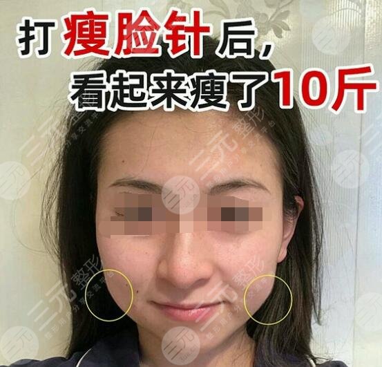 真人體驗注射瘦臉注射前