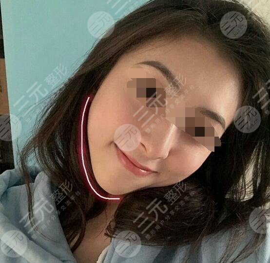 真人體驗注射瘦臉注射后一個月