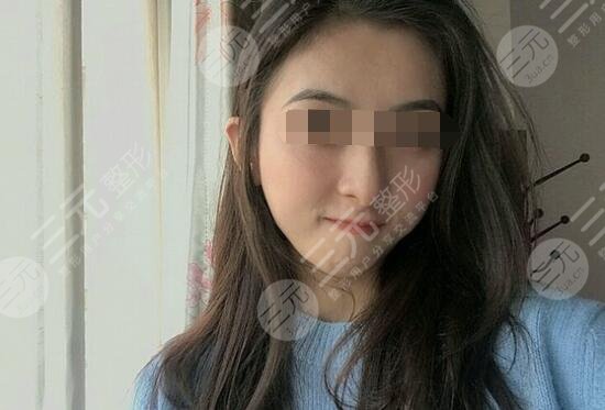 真人體驗注射瘦臉注射后2個月