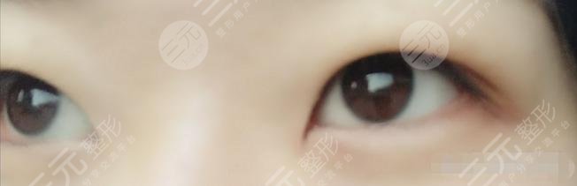 蘭大二院整形科專家雙眼皮案例