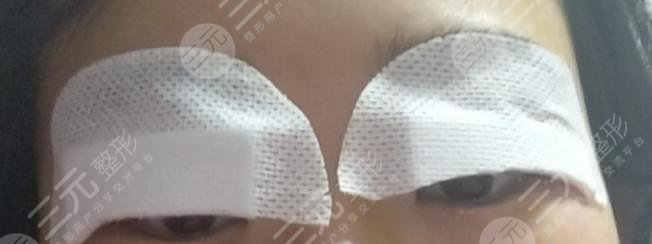 蘭大二院整形科專家雙眼皮案例