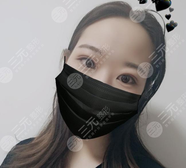 蘭大二院整形科專家雙眼皮案例