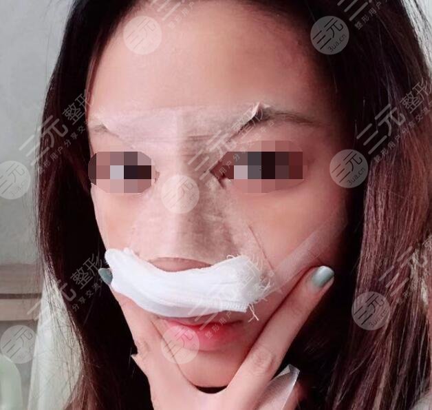 八大處周栩做鼻子隆鼻案例后一周