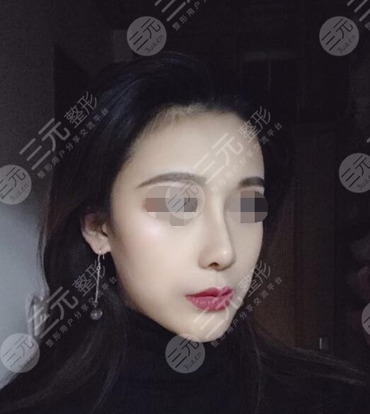 八大處周栩做鼻子隆鼻案例后5周