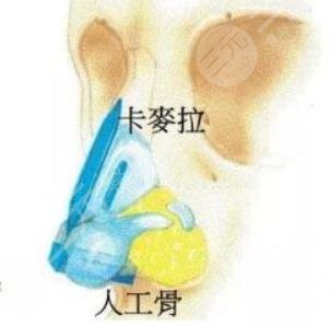 人工骨隆鼻吸收率是多少