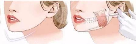 什么是注射瘦臉