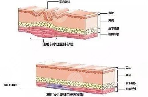 注射瘦腿?的價(jià)格與產(chǎn)品質(zhì)量有關(guān)