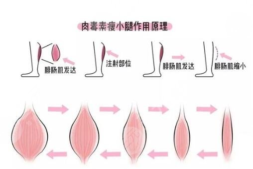 進(jìn)口注射瘦臉能瘦小腿嗎