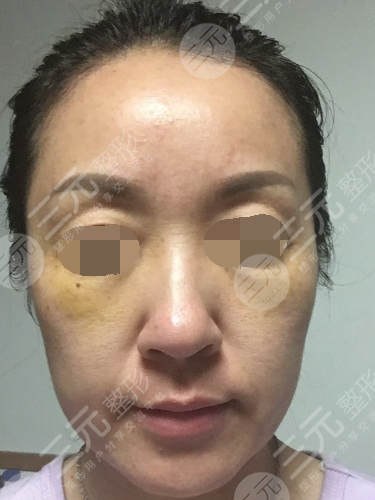 面部年輕化plus全臉，快速解決面部問題，內(nèi)附真實案例分享圖