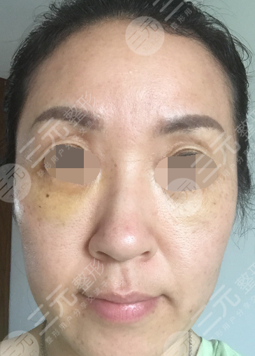 面部年輕化plus全臉，快速解決面部問題，內(nèi)附真實案例分享圖